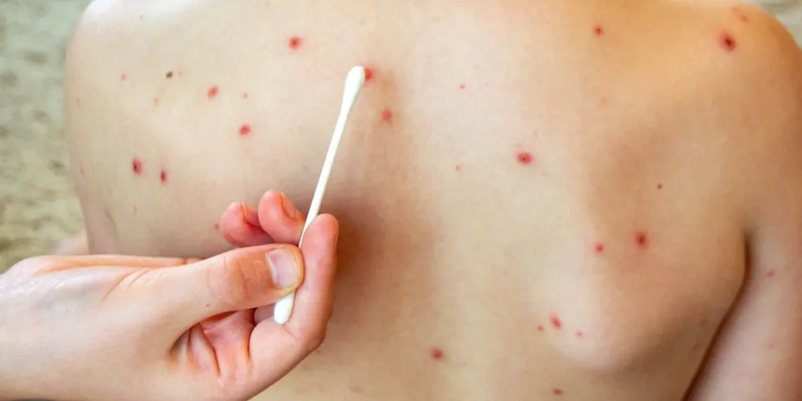 Suman 112 casos de sarampión en Puebla; aumentan 10 en 24 horas