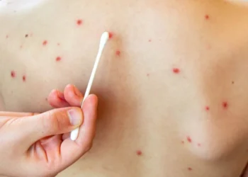 Suman 112 casos de sarampión en Puebla; aumentan 10 en 24 horas